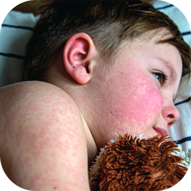 Young boy lying on bed with measles rash