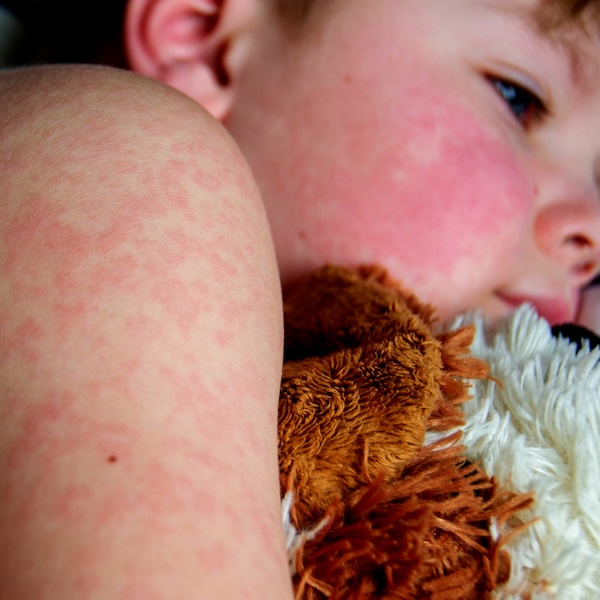 A young boy with measles resting on his bed
