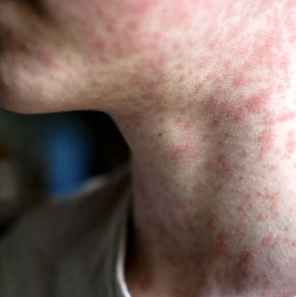 A close-up, slightly angled shot shows a person's neck and jawline covered in a rash of small, red bumps due to measles. 
