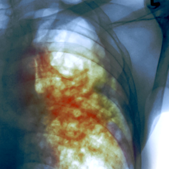 Tuberculosis x-ray showing affected lungs