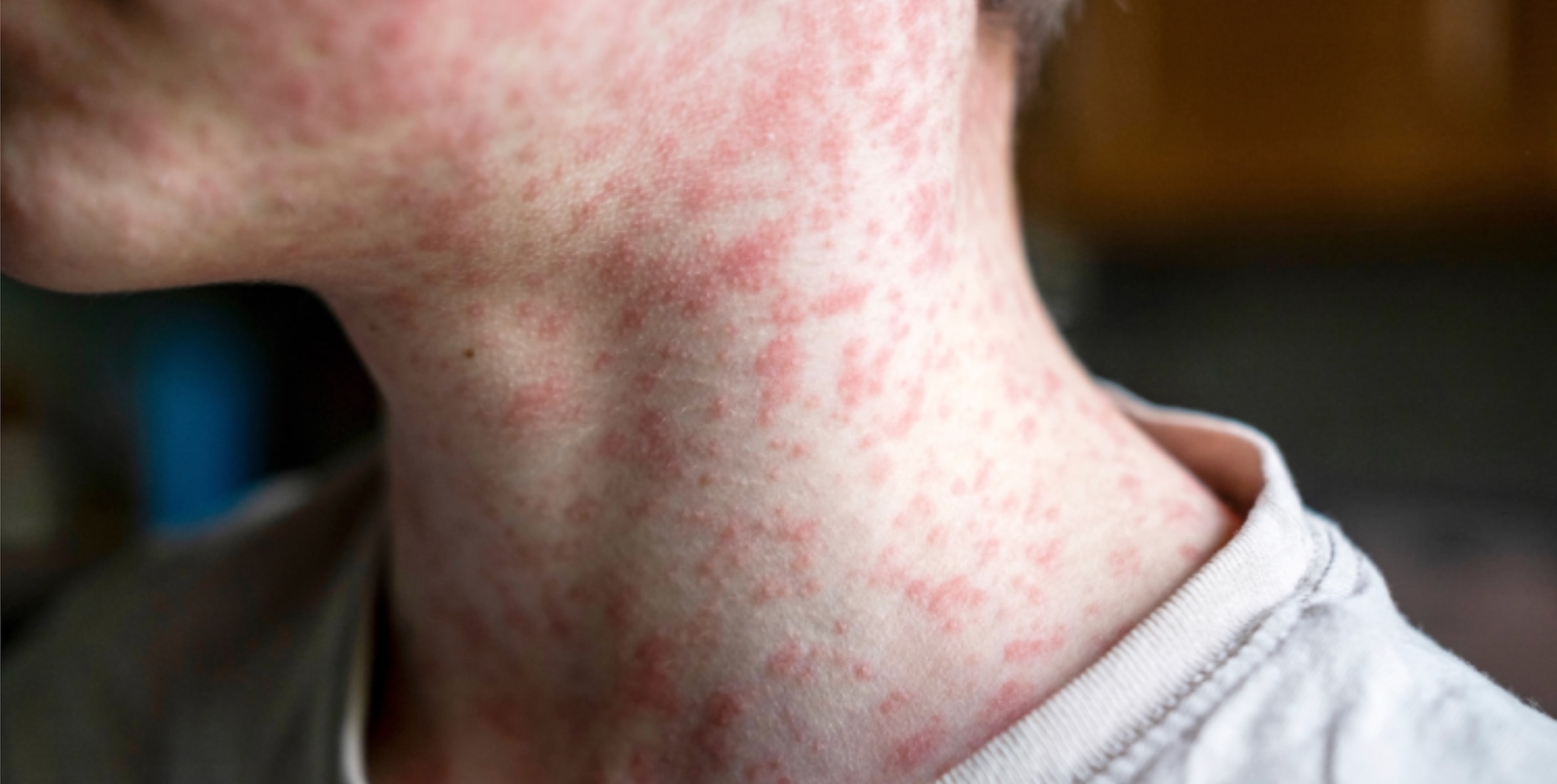 A close-up, side-profile shot focuses on the neck and jawline of a person, revealing a rash of small, red bumps scattered across their skin due to measles infection. The skin appears fair, and the rash is concentrated on the neck, extending slightly up towards the jaw and down towards the collarbone. 