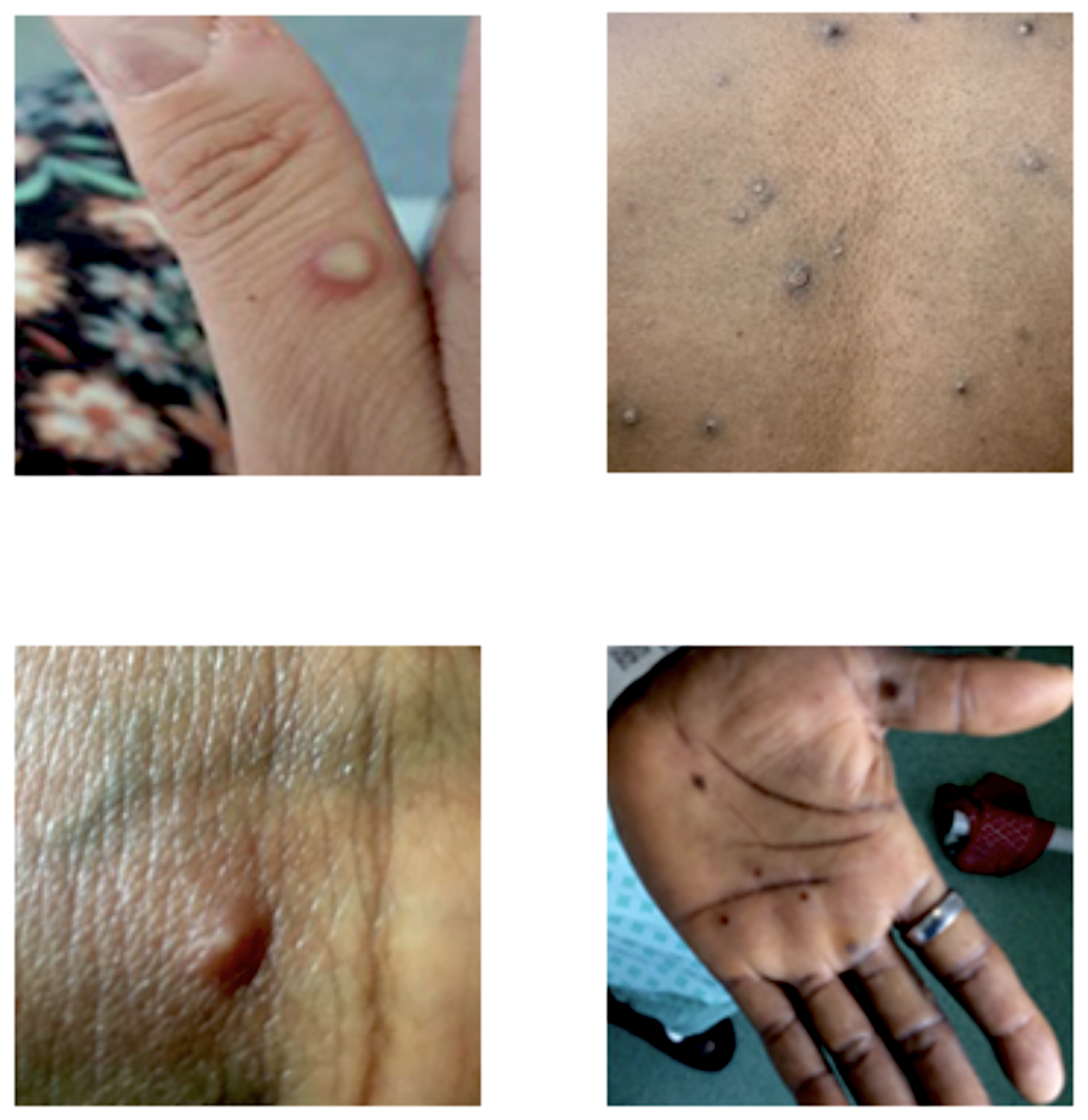 Four examples of Mpox rashes from the National Health Services of England