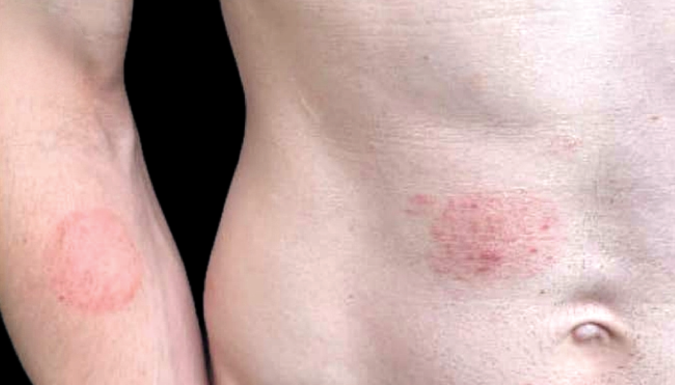 Patient with rash symptoms from Trichophyton mentagrophytes genotype VII (TMVII)