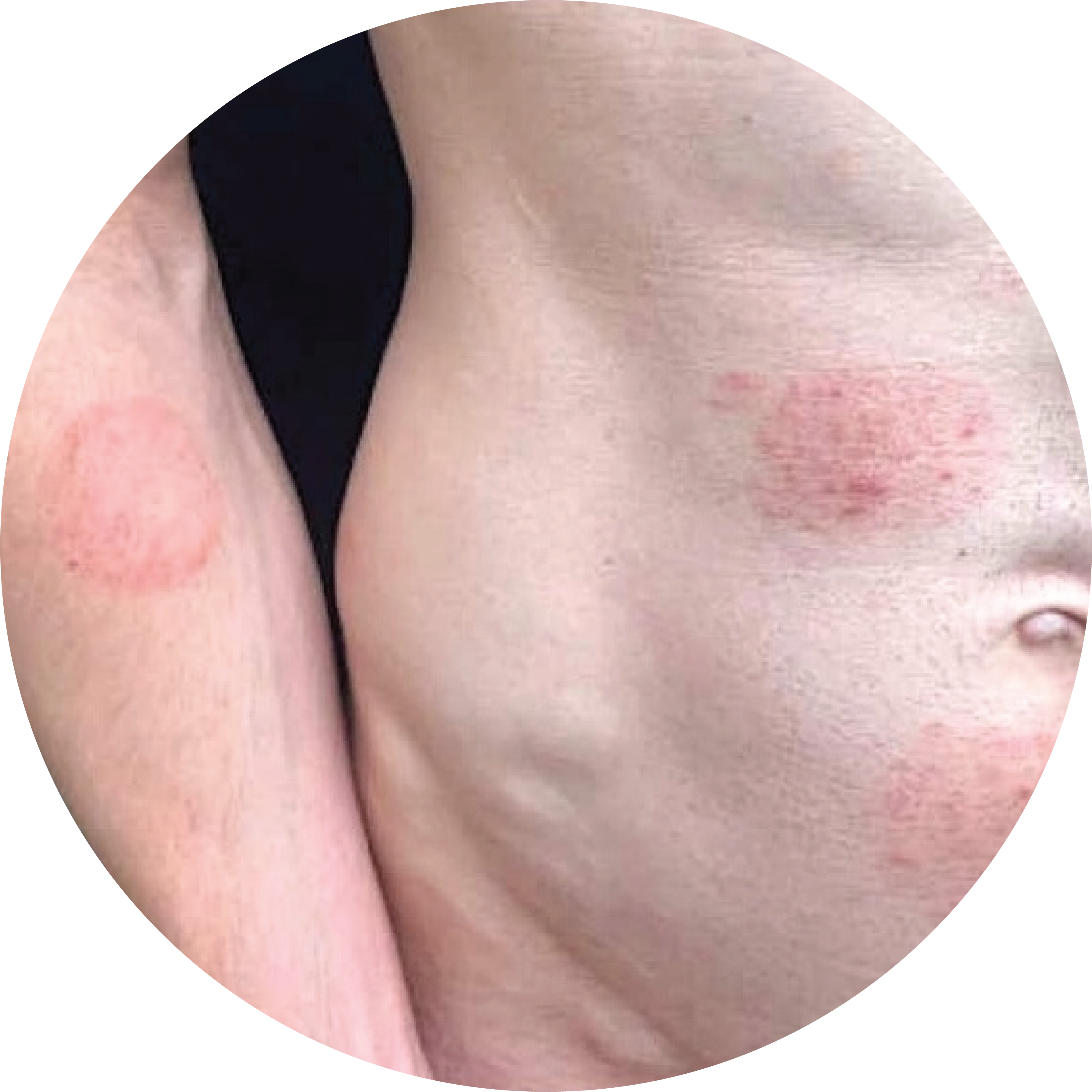 A patient with rashes from Trichophyton mentagrophytes genotype VII (TMVII)