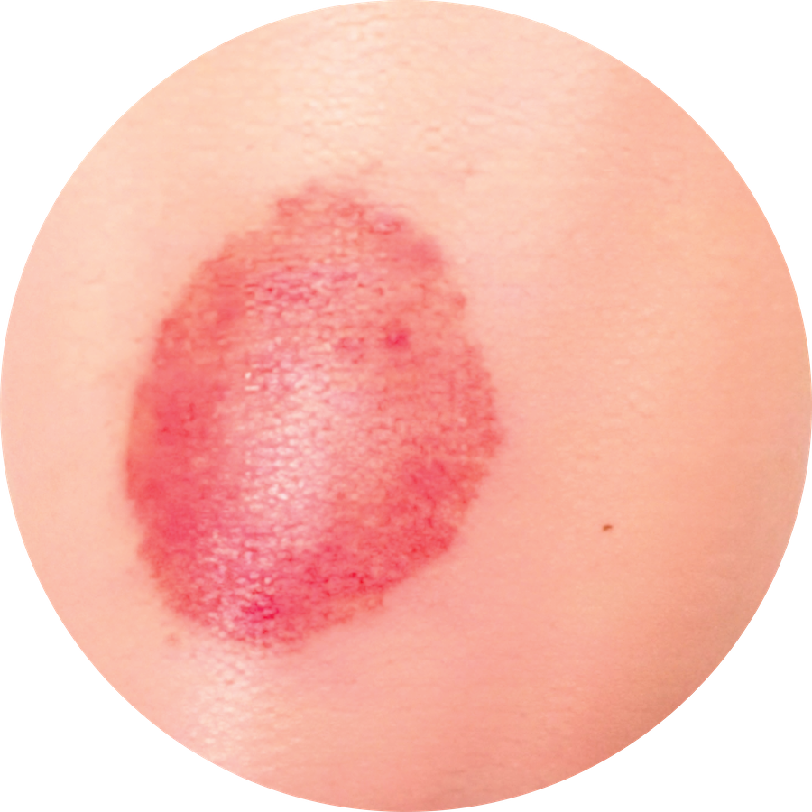 TMVII rash on a skin surface