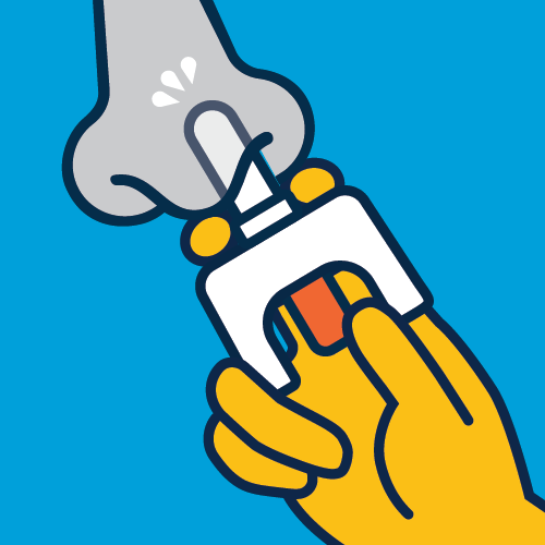 An illustration of administering naloxone nasal spray. A hand holds naloxone with pointer and middle finger on either side, and thumb on the plunger. The spray is inserted all the way into a nostril, and droplets indicate dispensing the medication. 